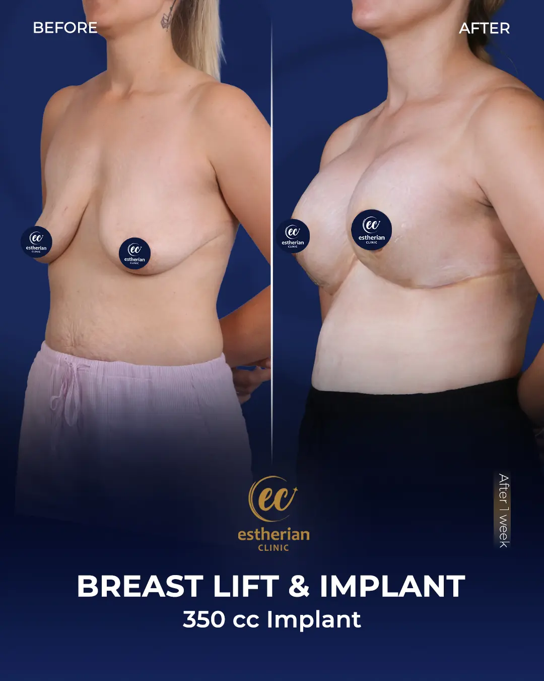 Breast-implant-Lift-350cc implants