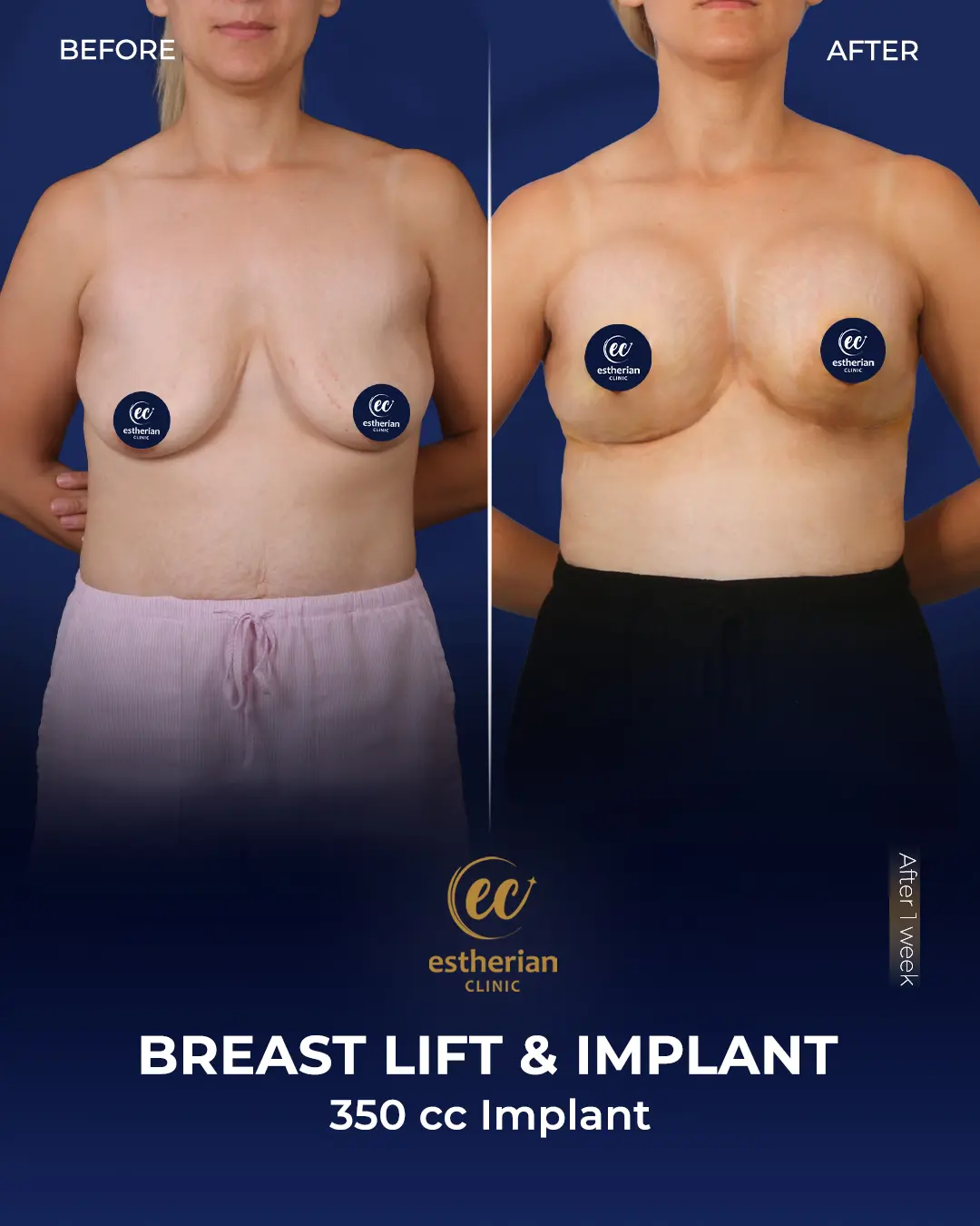 Breast-implant-lift-350ccimplants
