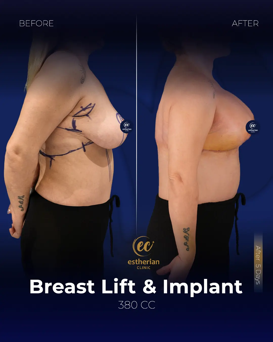 Breast lift and Implant 380cc