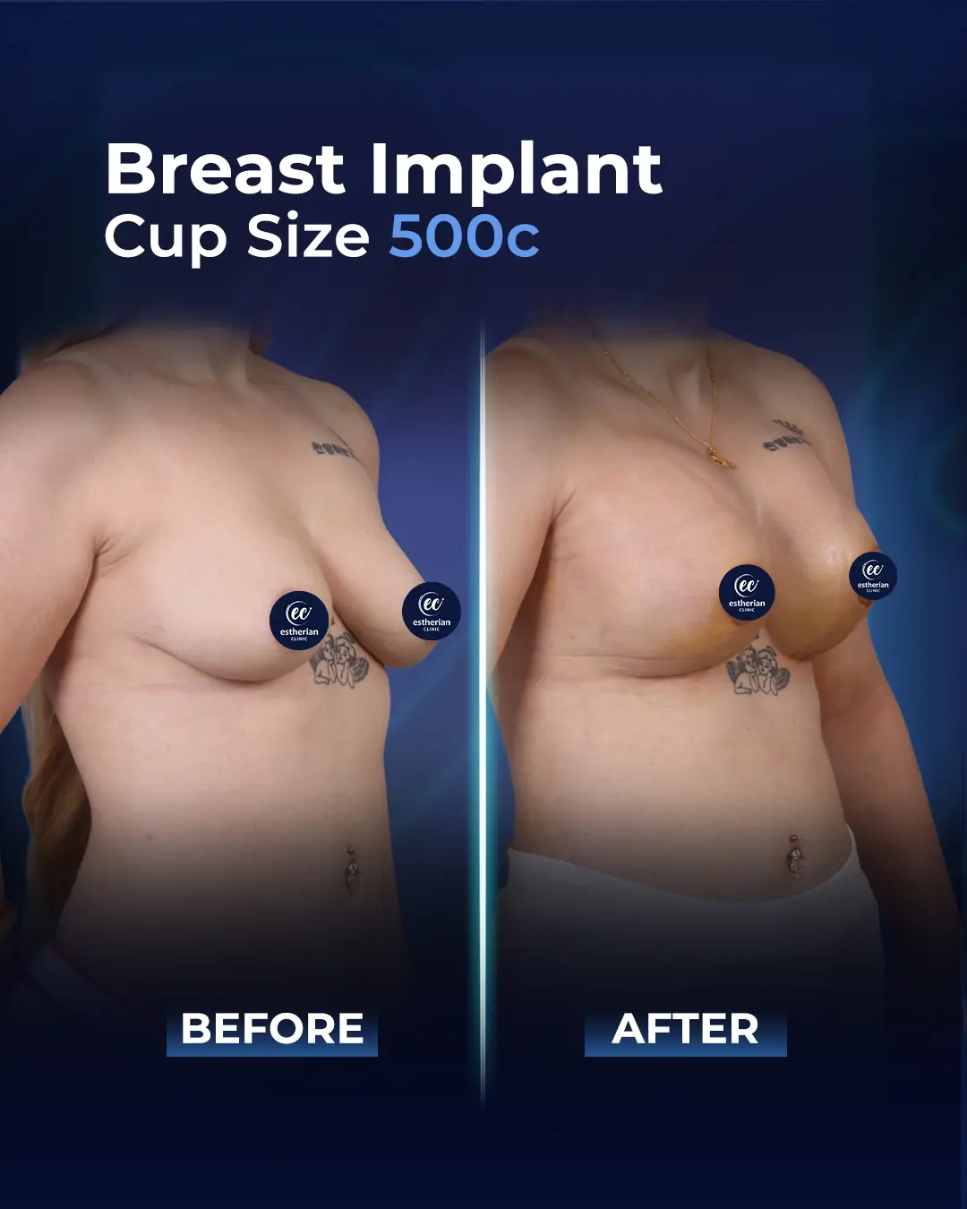 Breast lift and Implant 500cc
