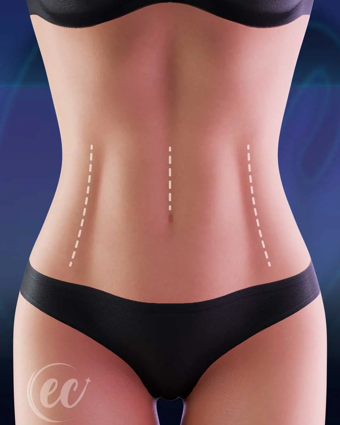 Defined Abs - Abdomial Etching (Two-packs Abs Surgery)