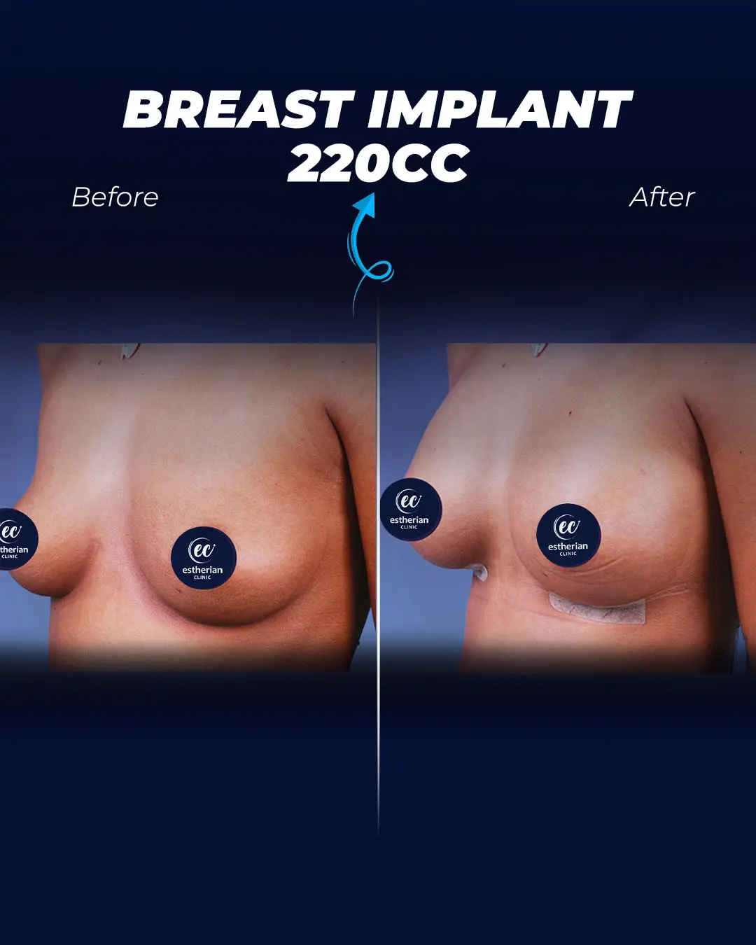Breast Implant 220CC-Teardrop