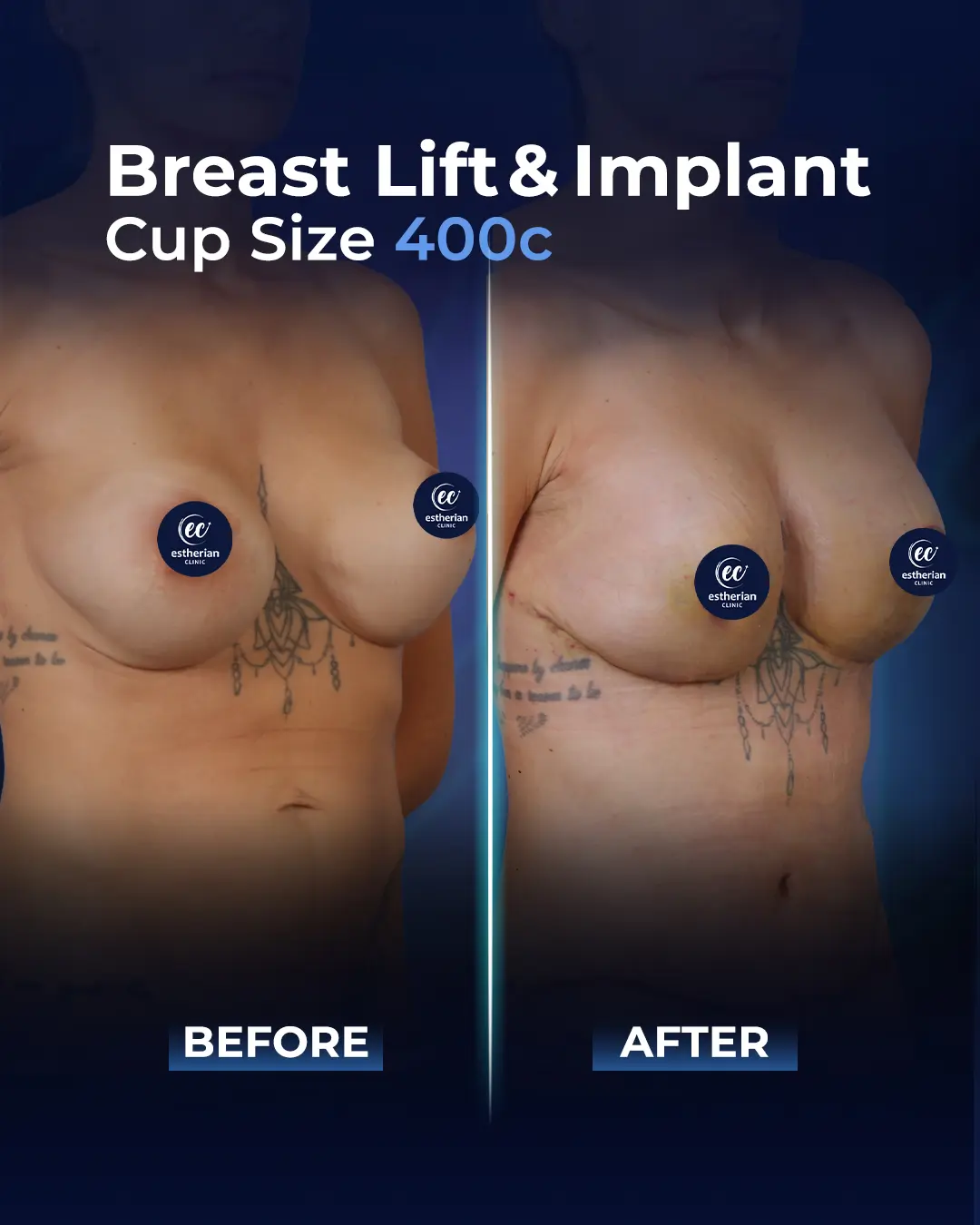 Breast Implants 700CC-Round