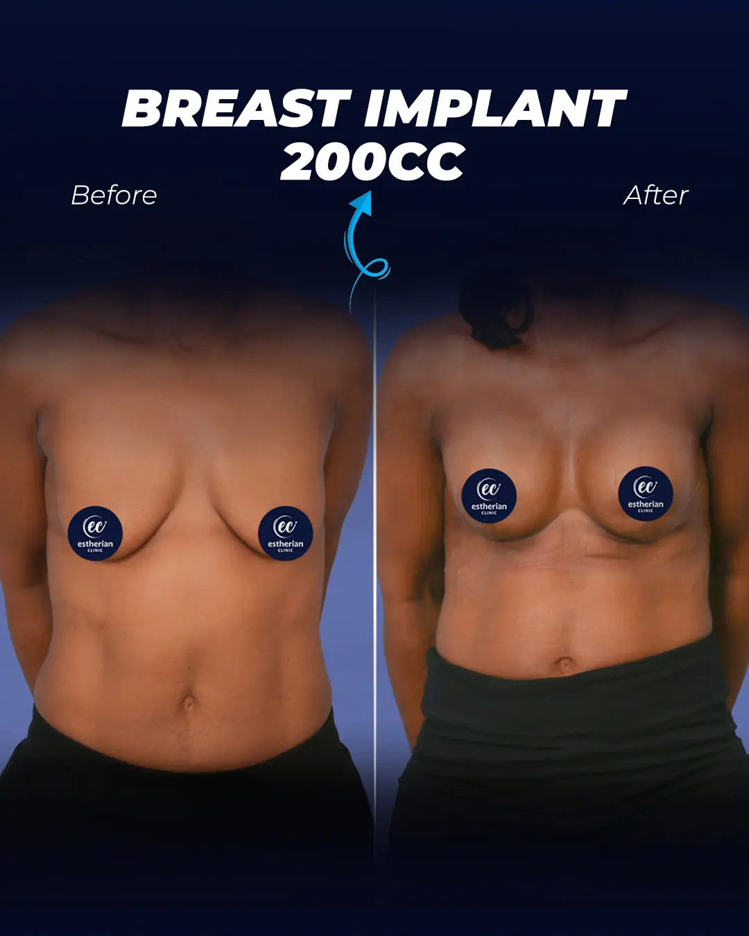 Breast Implants 200CC-Round