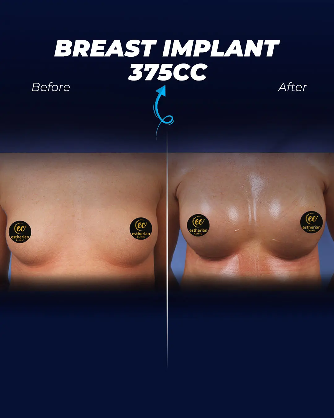 Breast Implants 375CC-Round