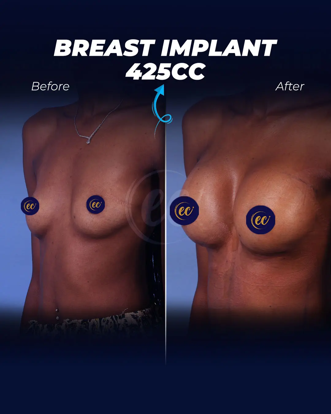 Breast Implants 425CC-Round