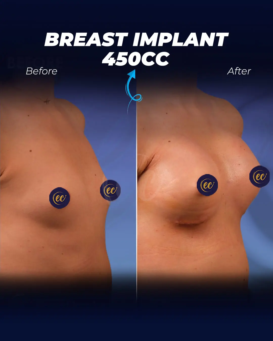 Breast Implants 450CC-Round