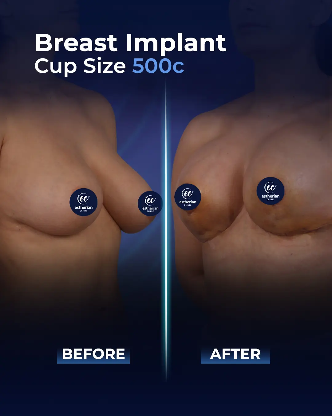 Breast Implants 500CC-Round