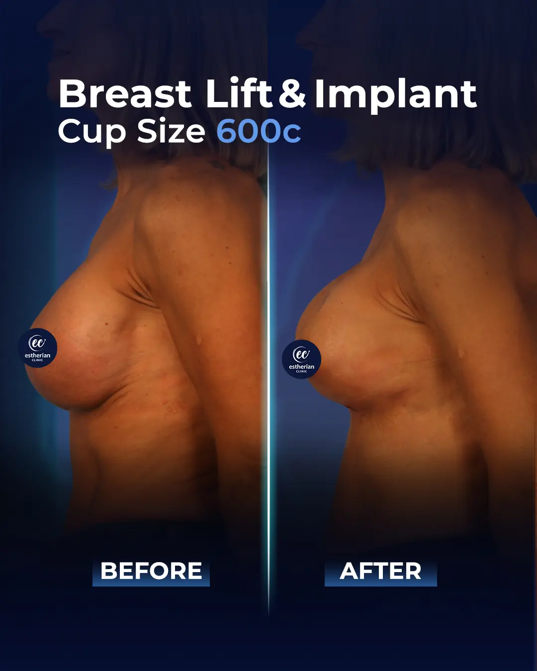 Breast Implants 600CC-Round