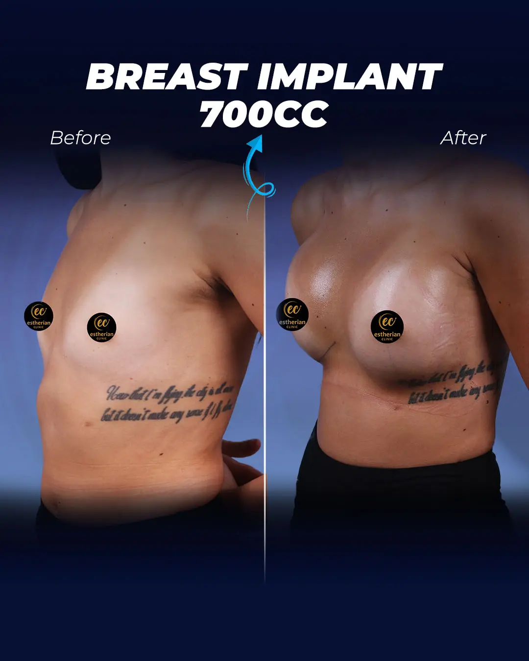 Breast Implants 700CC-Round