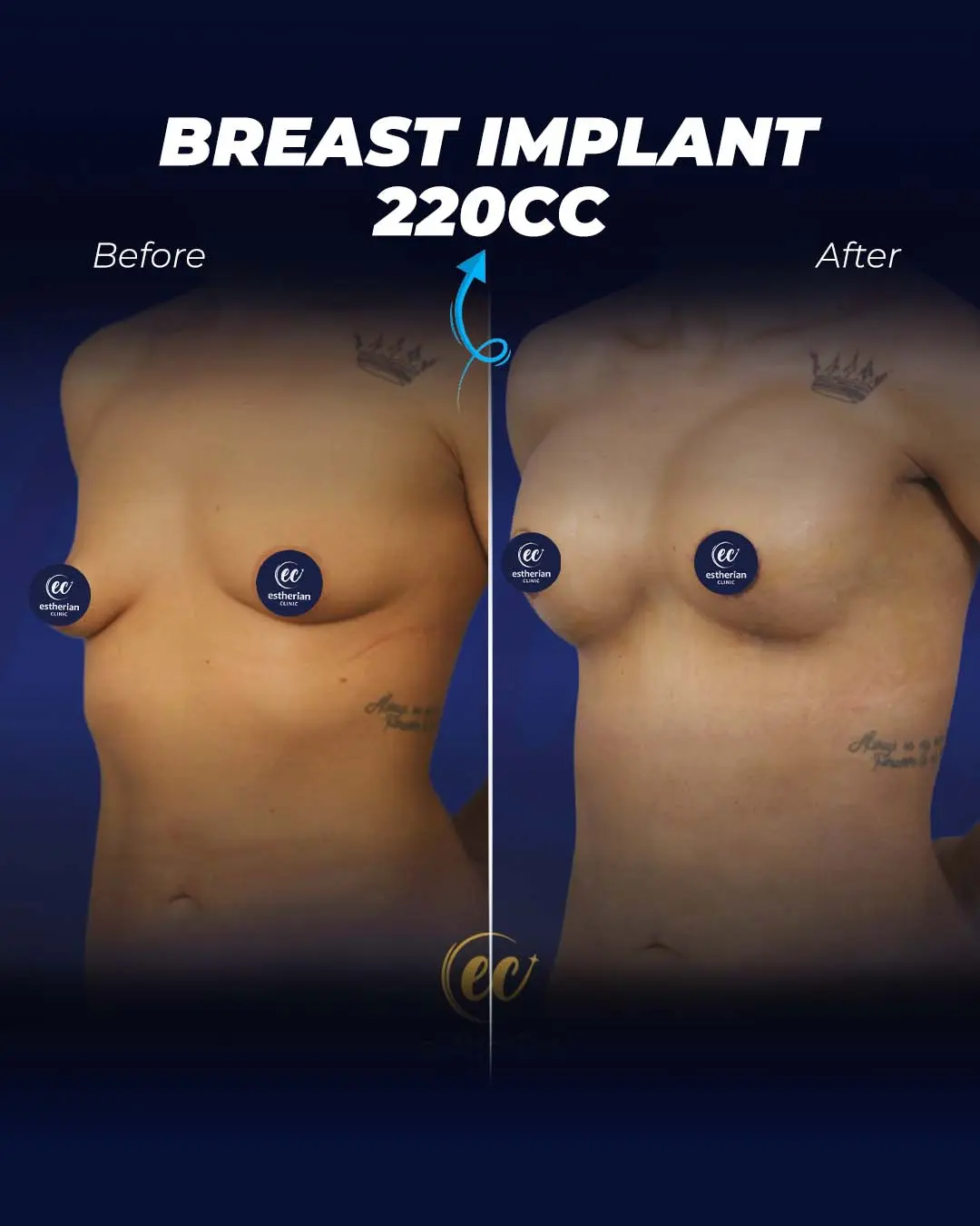 Breast Implant 20CC-Round