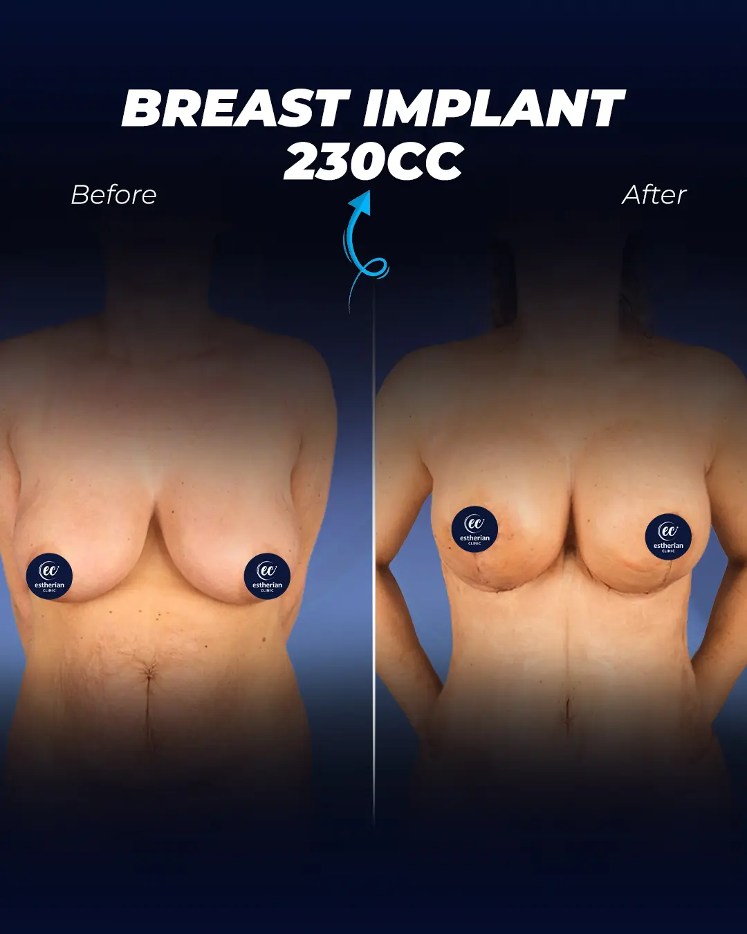 Breast Implants -230CC-Round