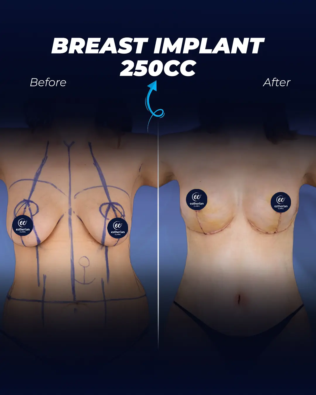 Breast Implants 250CC-Round