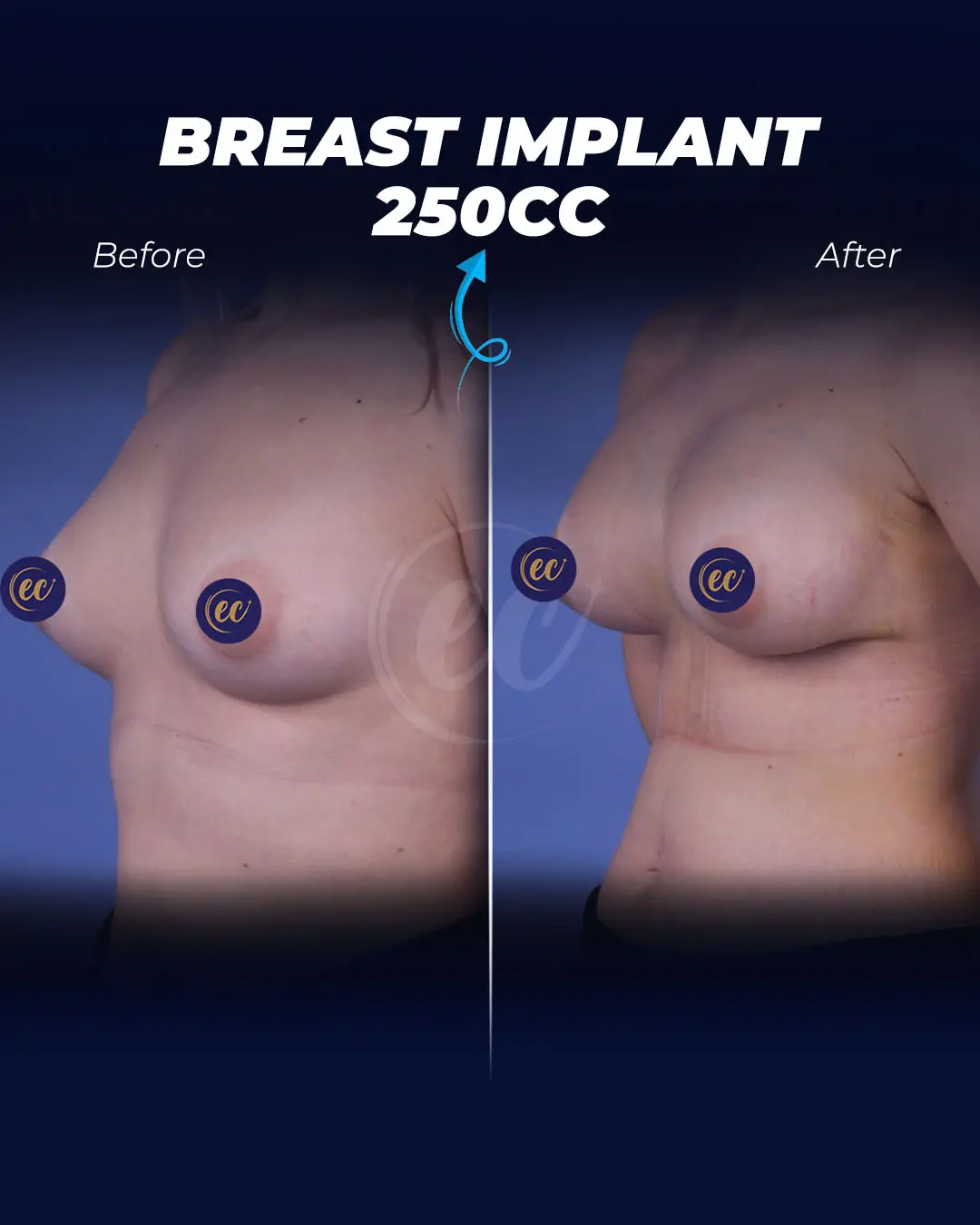 Breast Implant 250cc-Teardrop