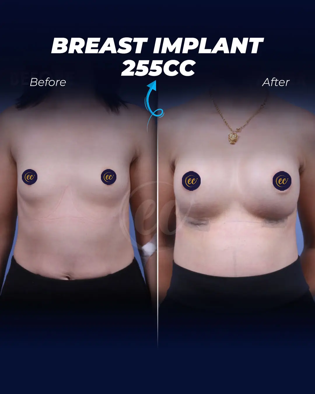 Breast Implants 255CC-Round
