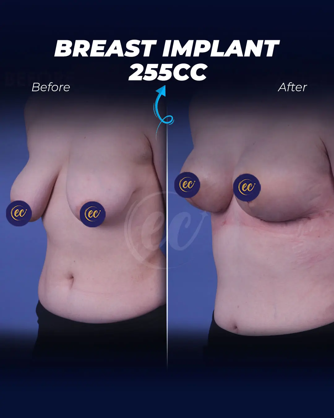 Breast Implants 255CC-Round.