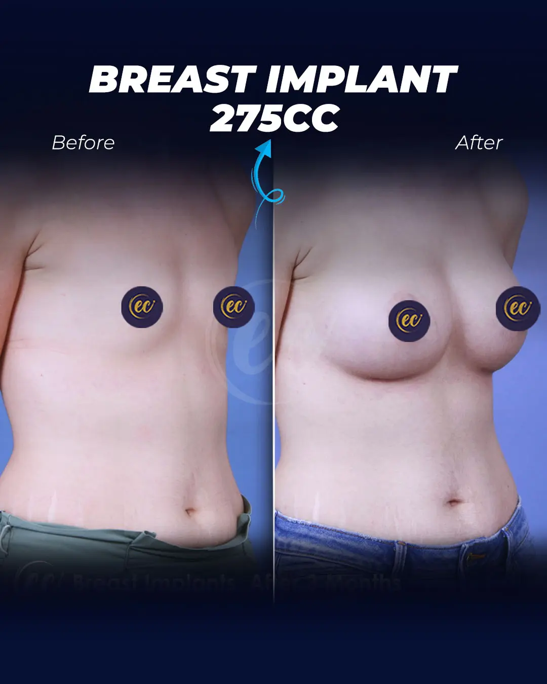 Breast Implants 275CC-Round