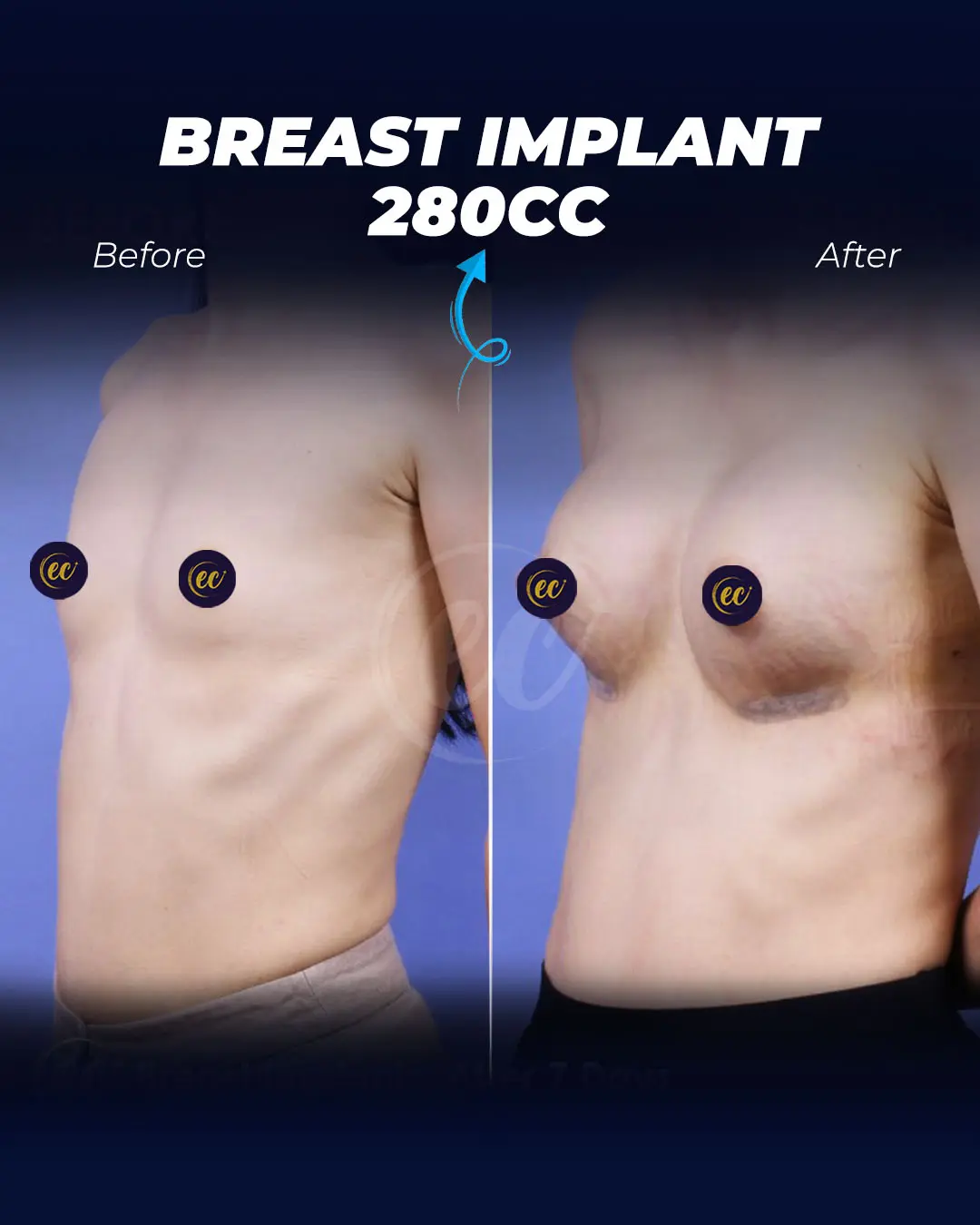 Breast Implants 280CC-Round