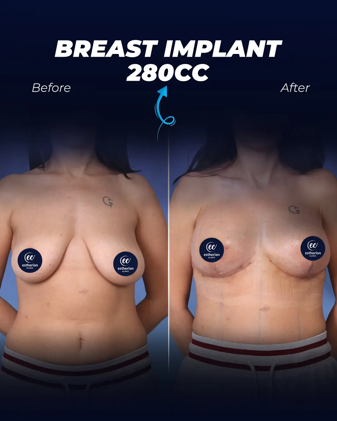 Breast Implants 280CC-Teardrop