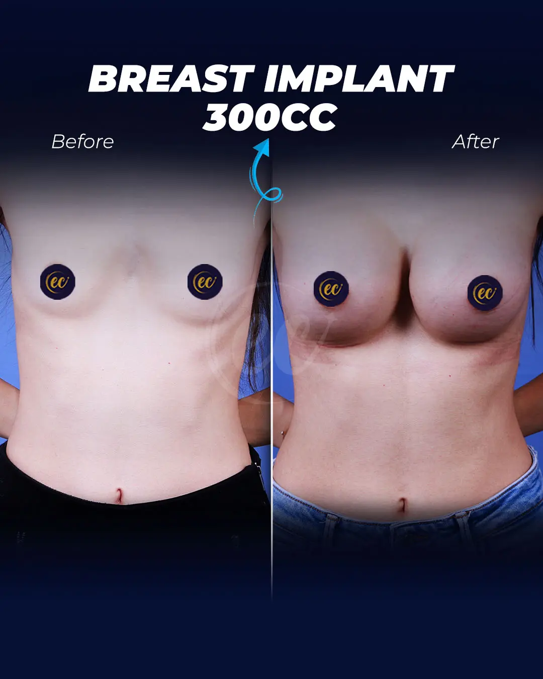 Breast Implants 300CC-Round