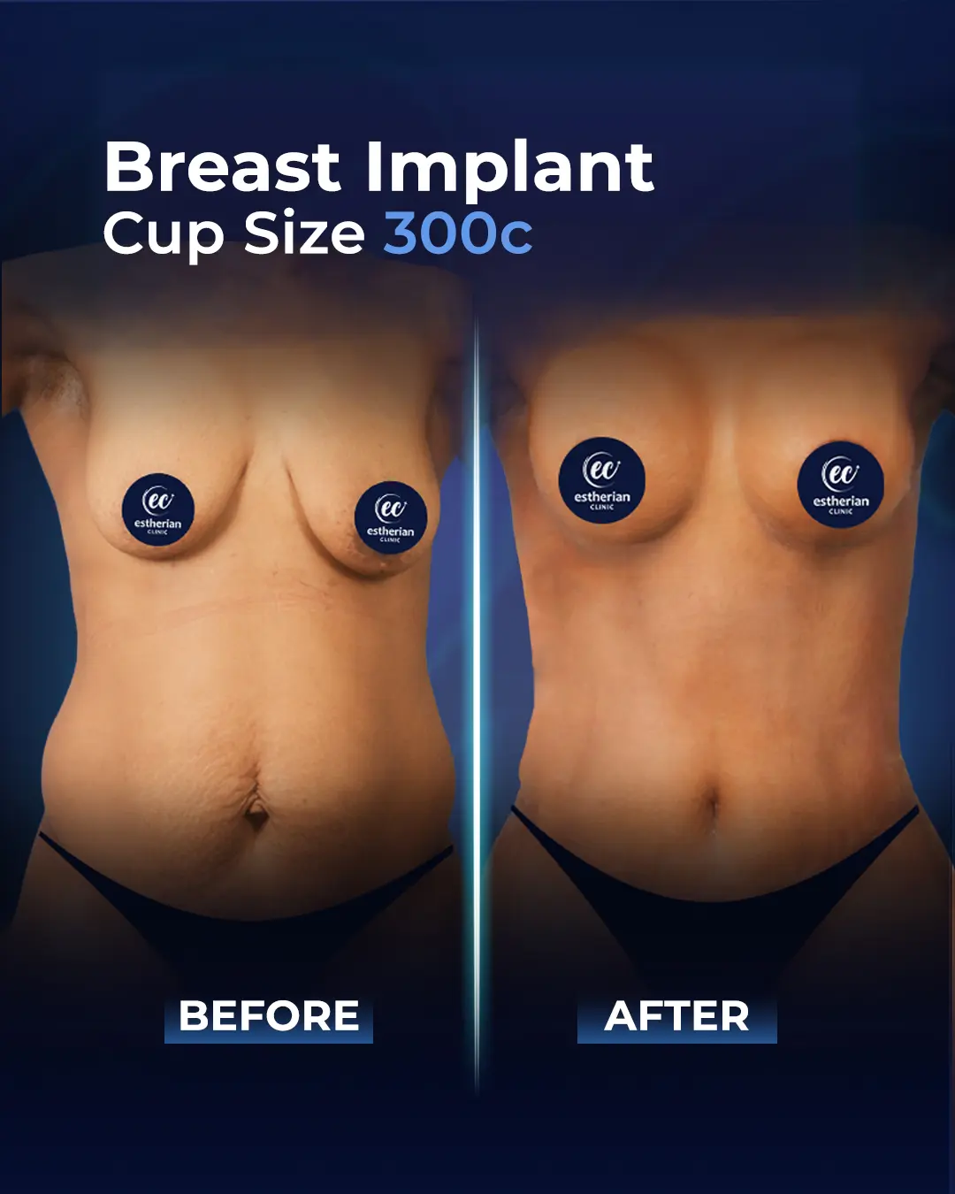Breast Implants 300CC-Round