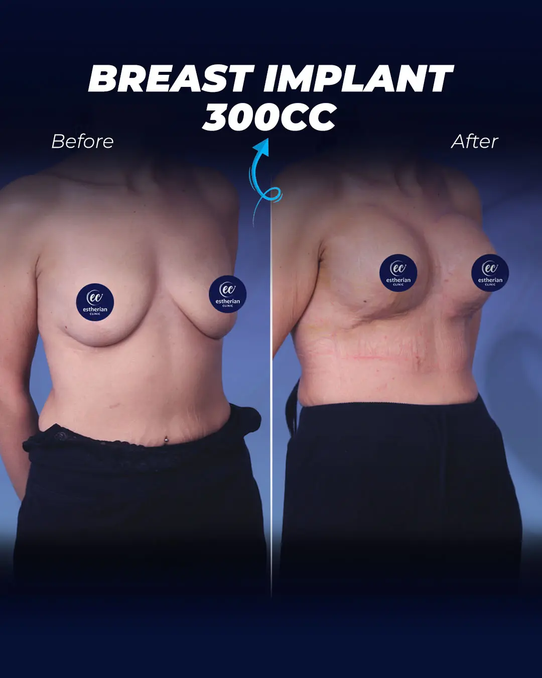 Breast Implants 300CC-Teardrop