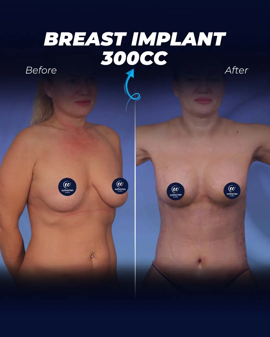 Breast Implant 300CC-Teardrop