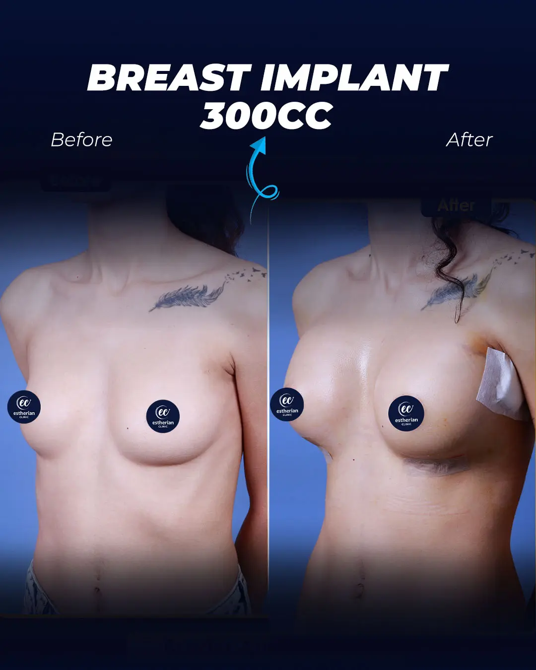 Breast Implants 300CC- Teardrop