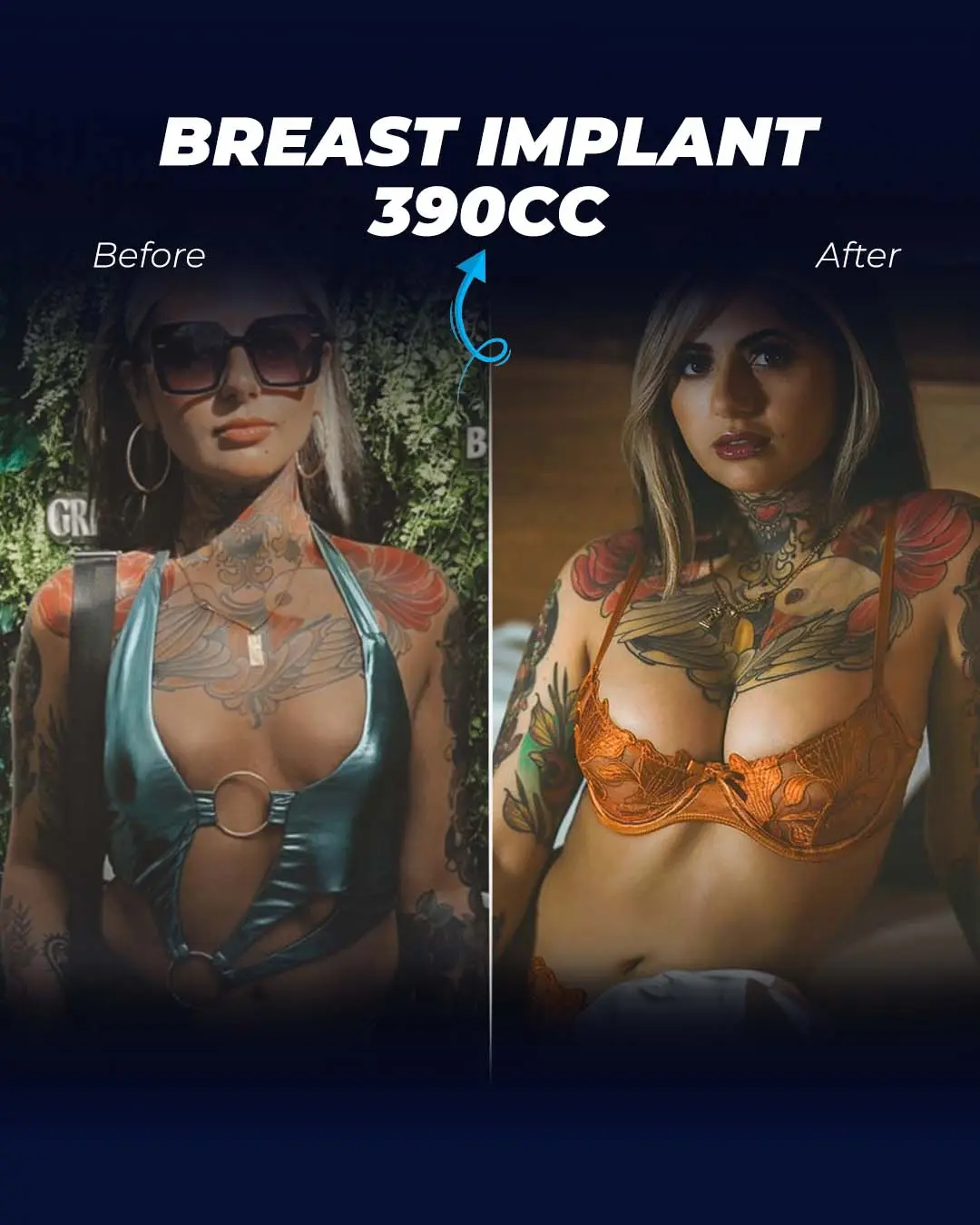 Breast Implant 30CC-Round