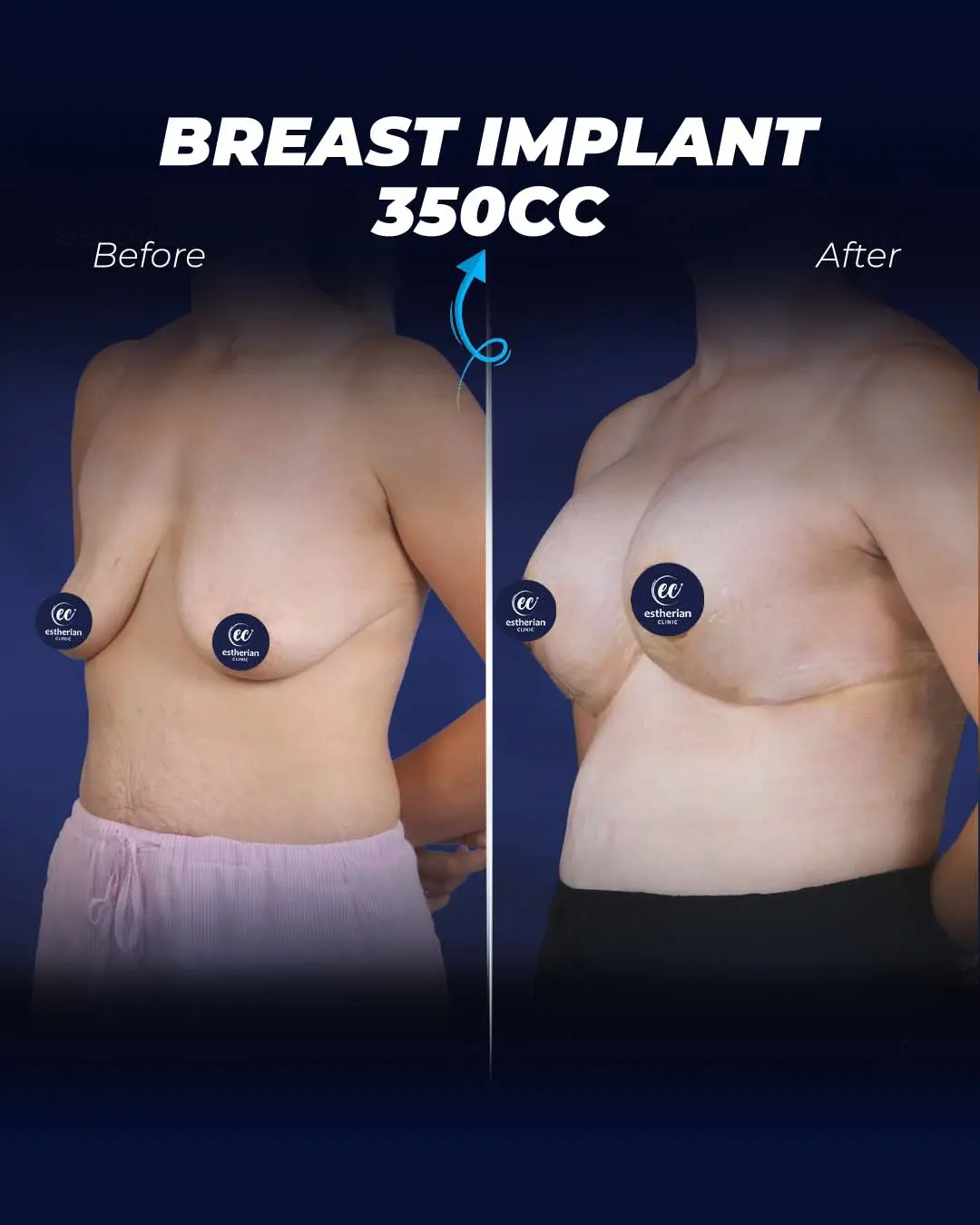 Breast Implant 350CC-Round