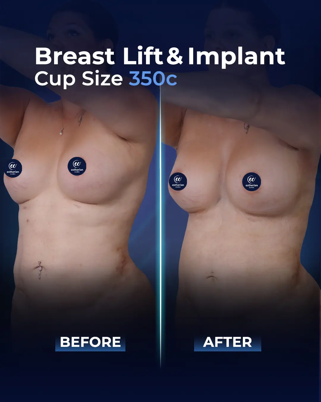 Breast Implants 350CC-Round
