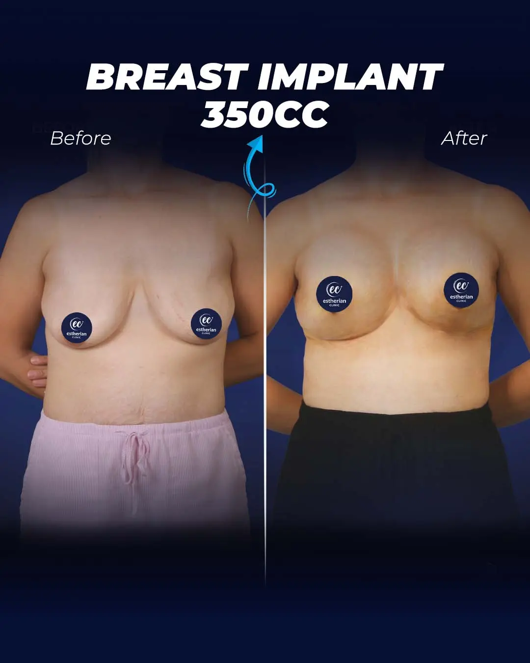 Breast Implant 350CC-Round