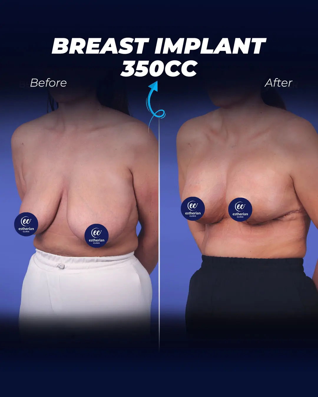 Breast Implants 350CC-Teadrop