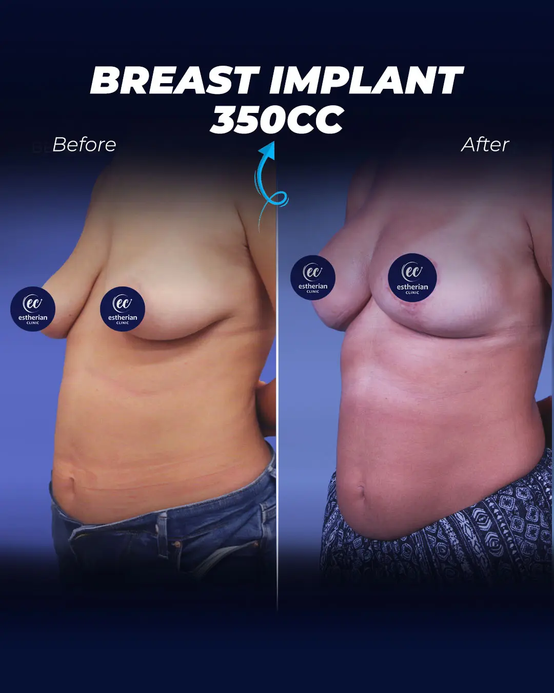 Breast Implants 350CC-Teardrop