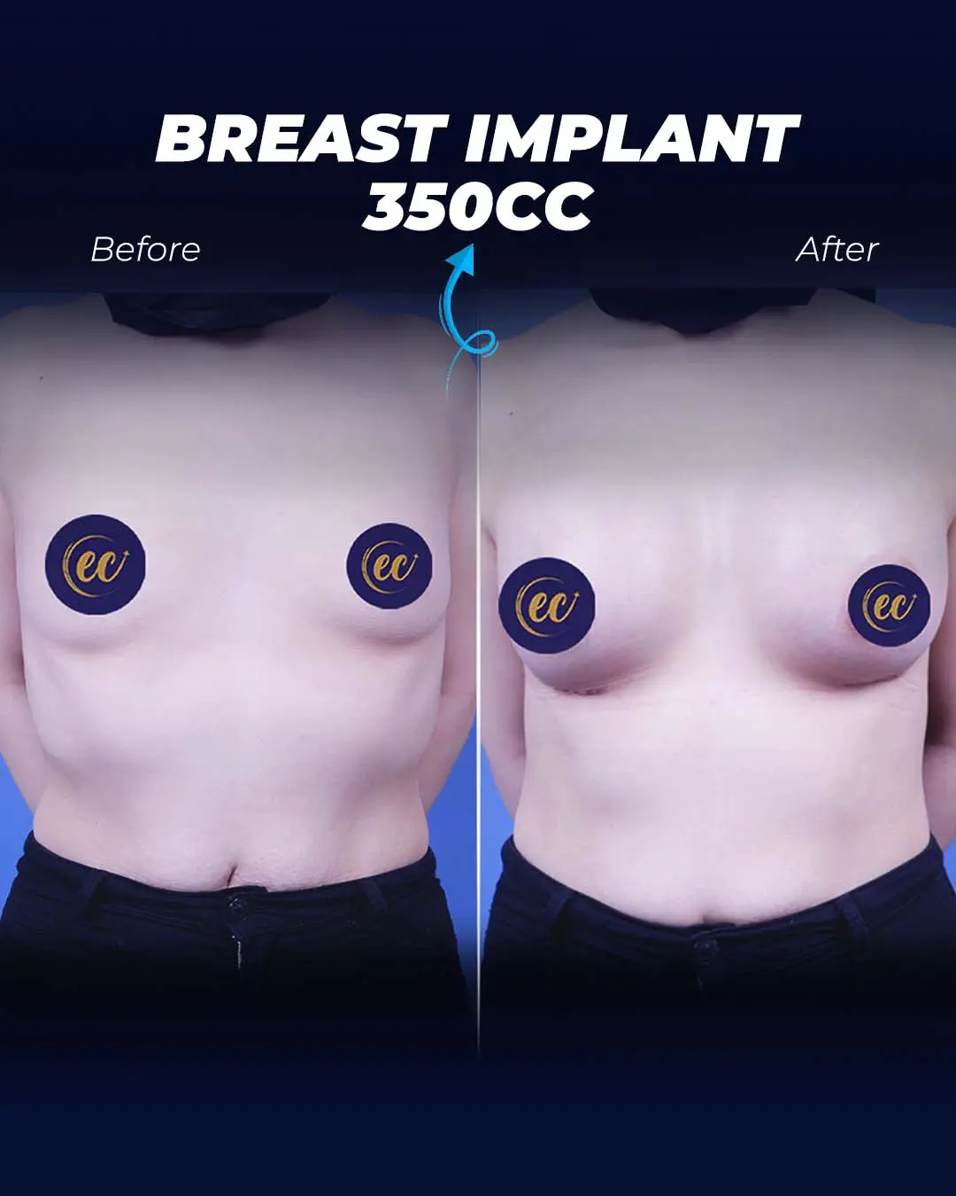 Breast Implant 350CC-Teardrop