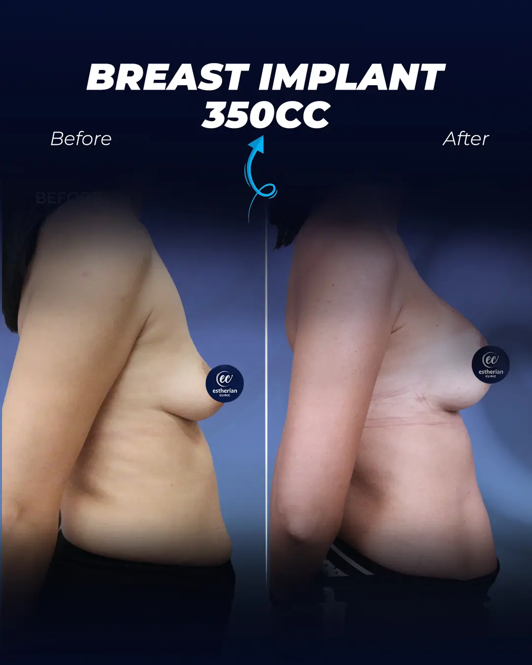 Breast Implants -350CC- Teardrop