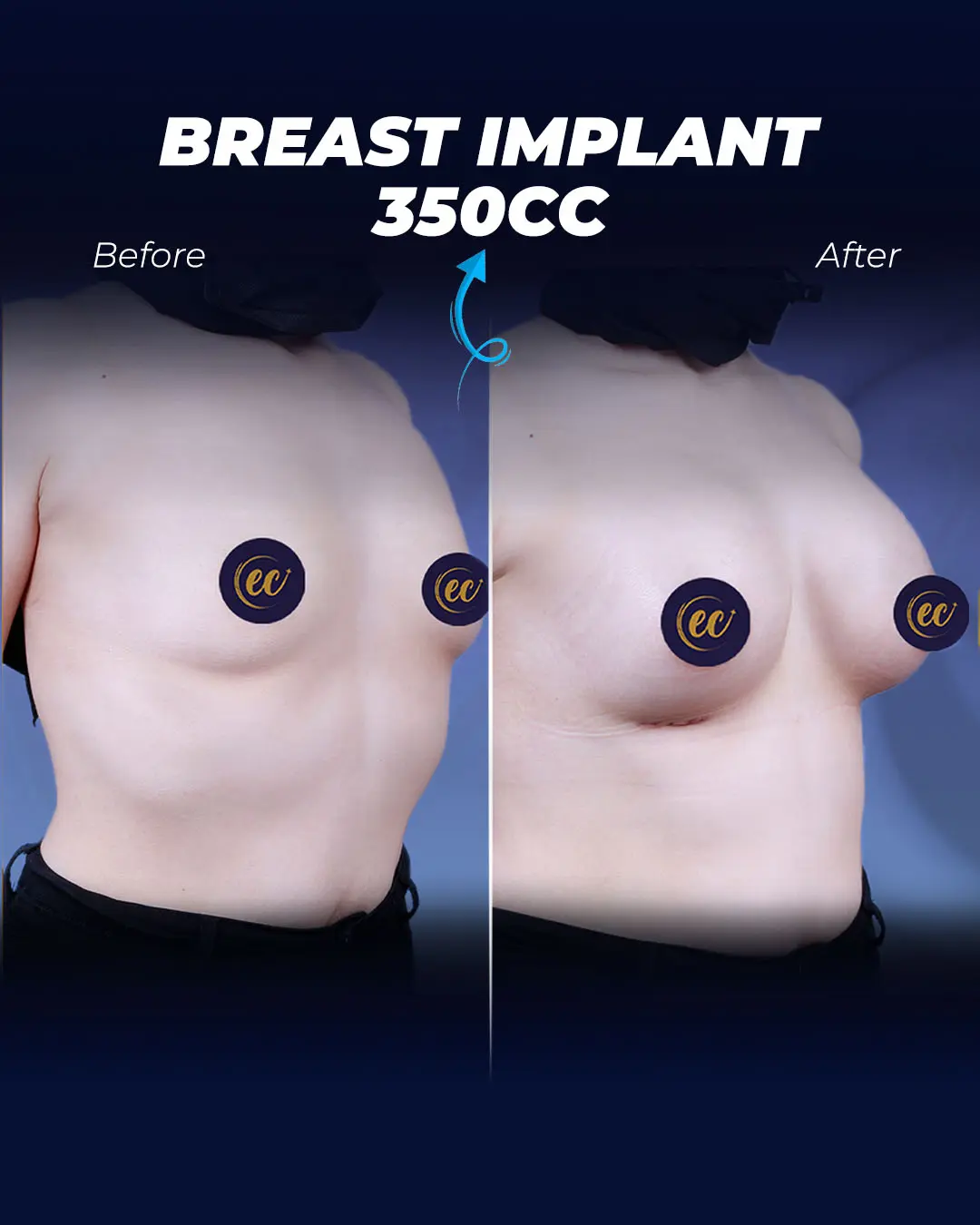 Breast Implants 350CCTeardrop