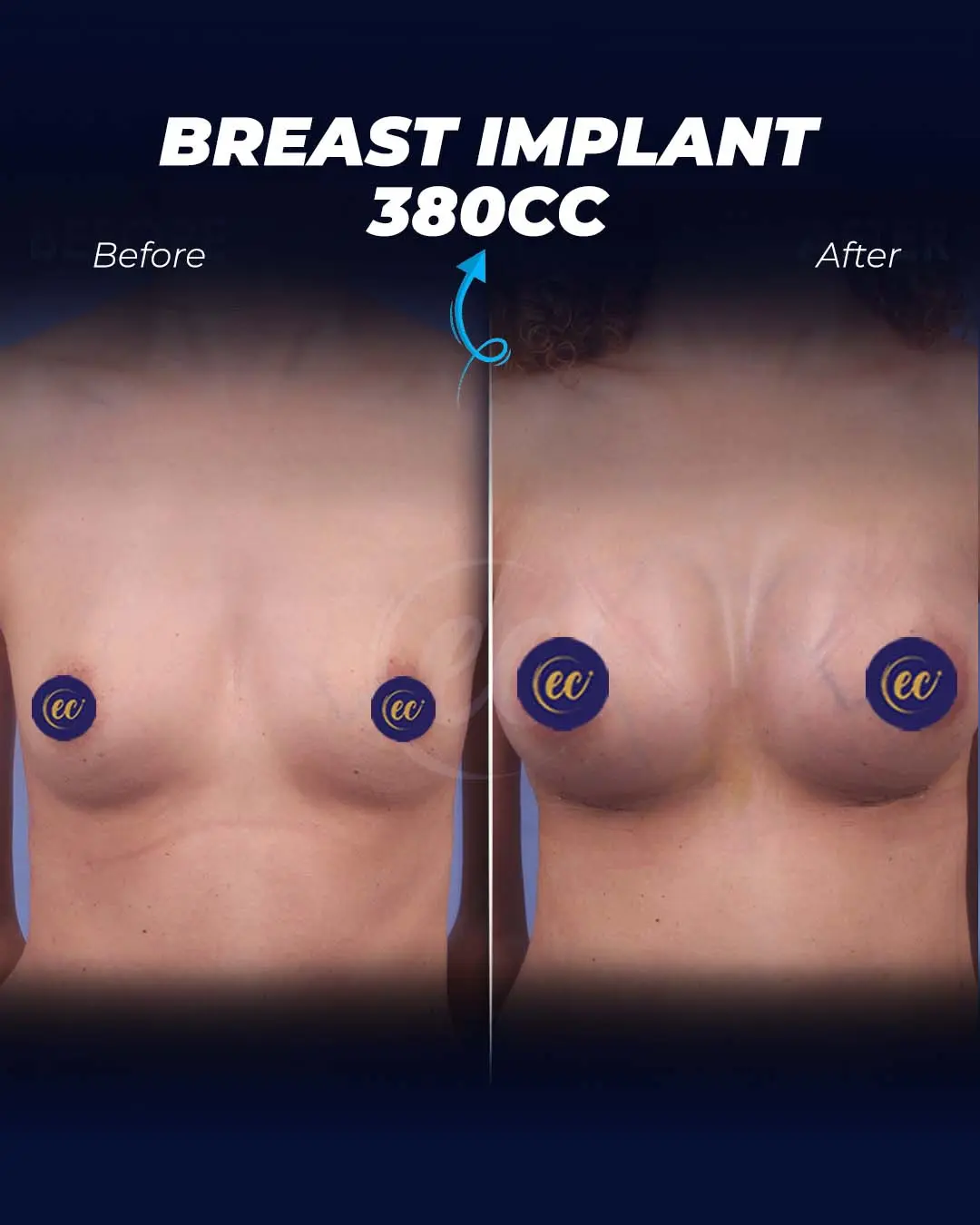 Breast Implant 380 CC-Round
