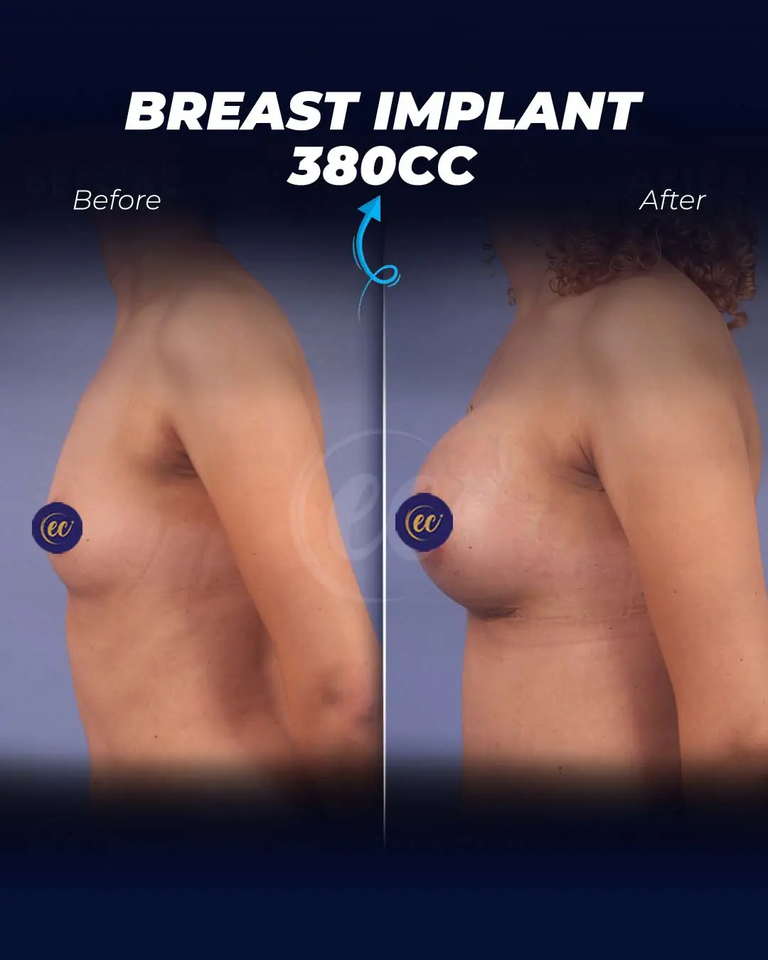 Breast Implant 380 CC-Round