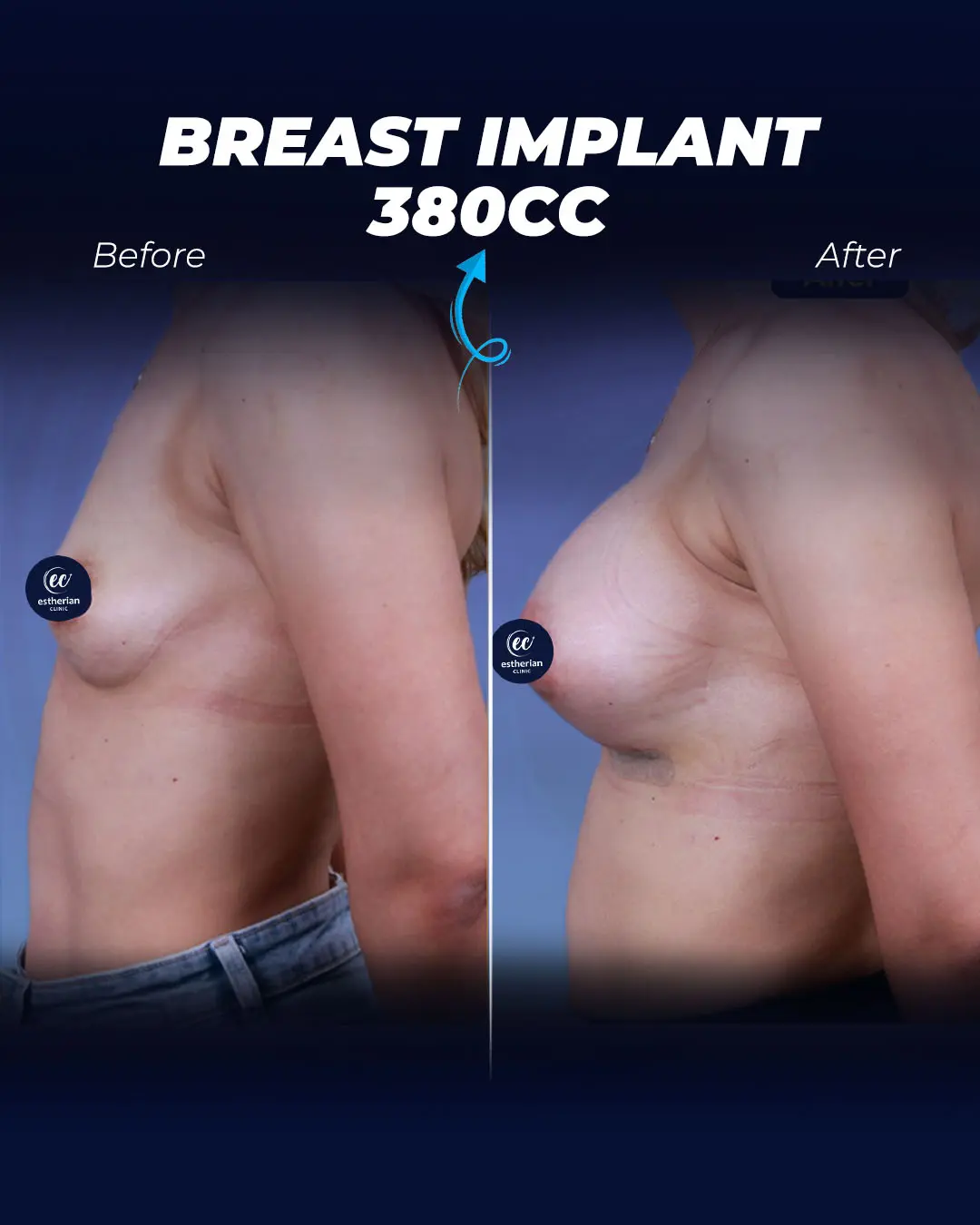 Breast Implants 380CC-Round