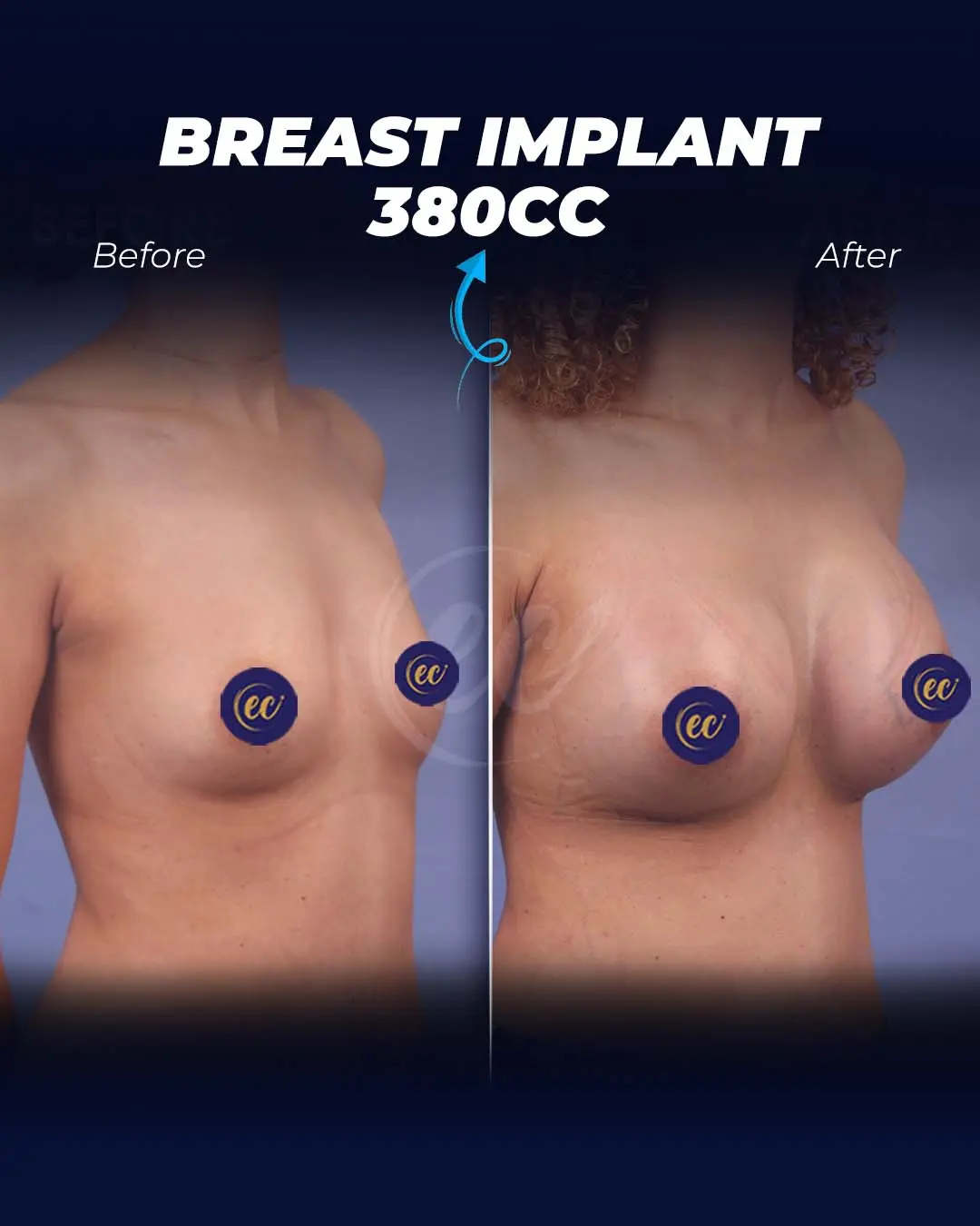 Breast Implant 380CC-Round