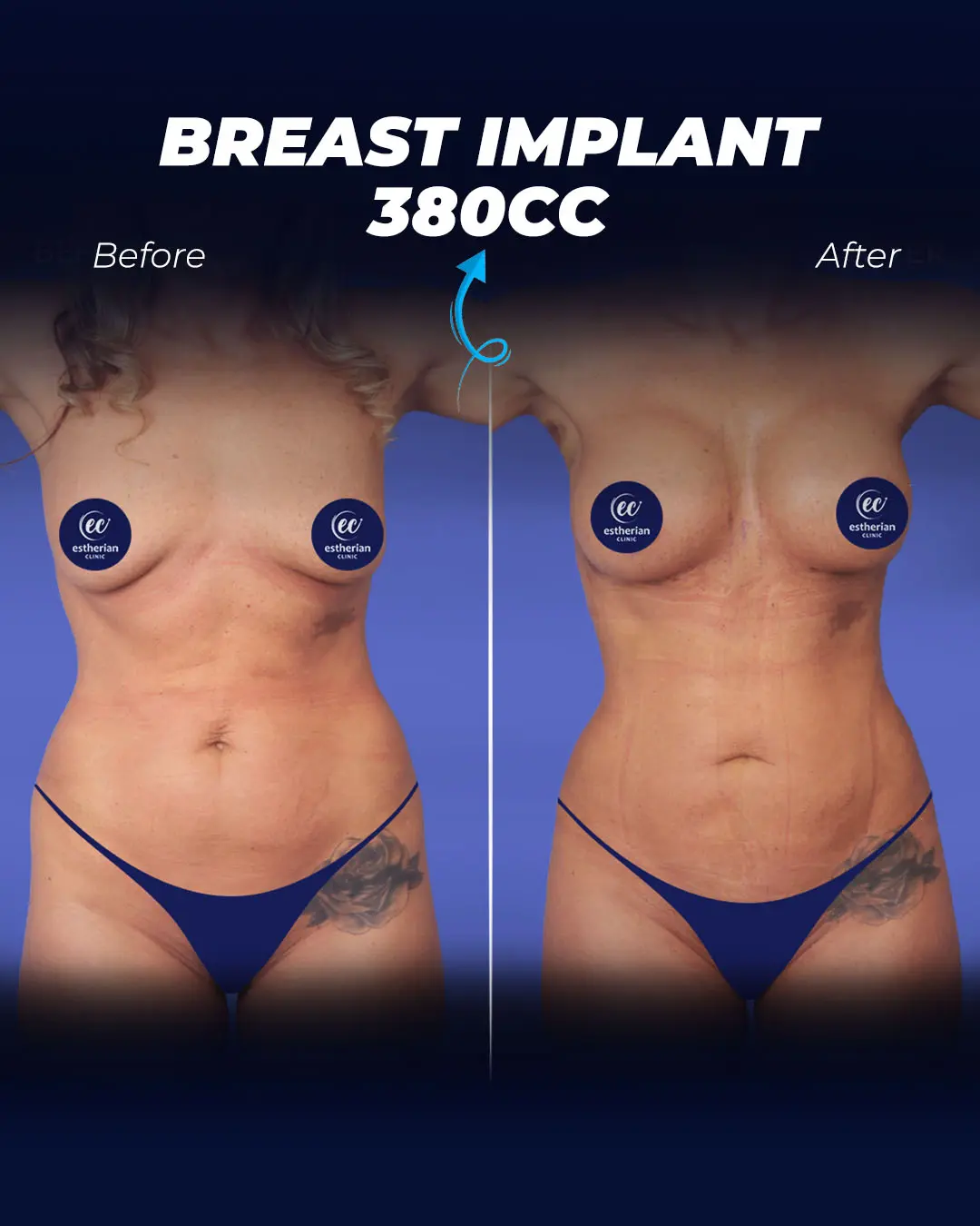 Breast Implants 380CC- Round