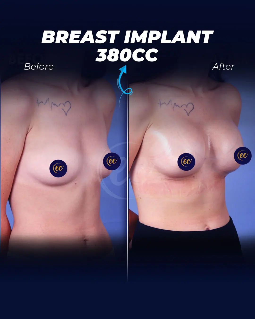 Breast Implants 380CC-Teardrop