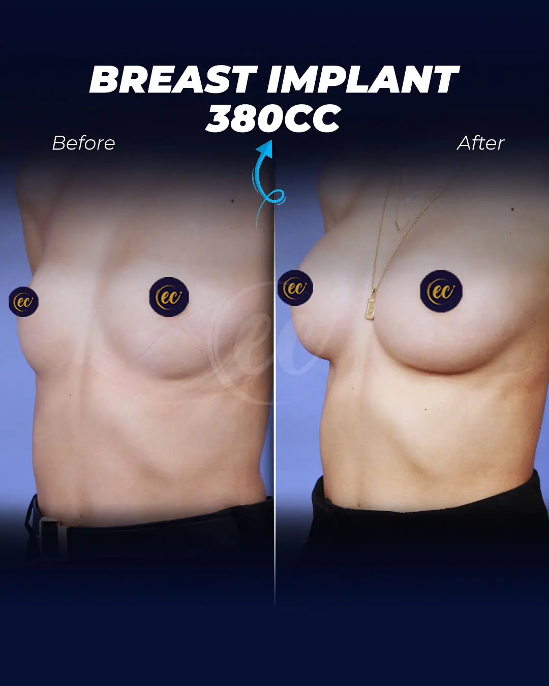 Breast Implants 380CC-Teardrop