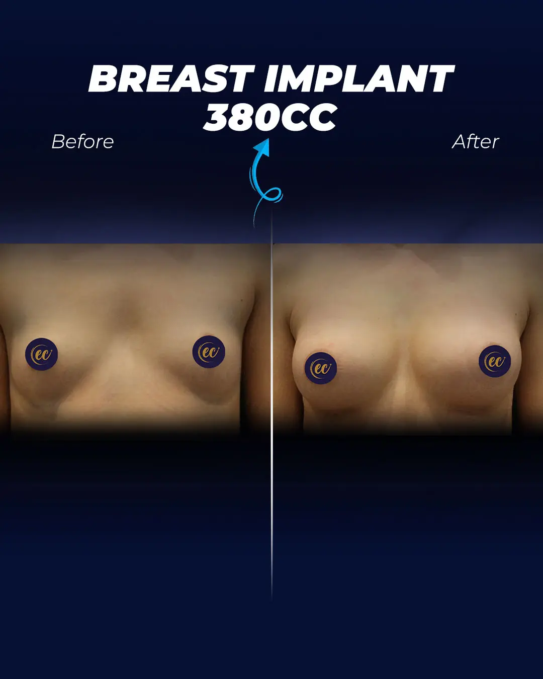 Breast Implants 380CC- Round