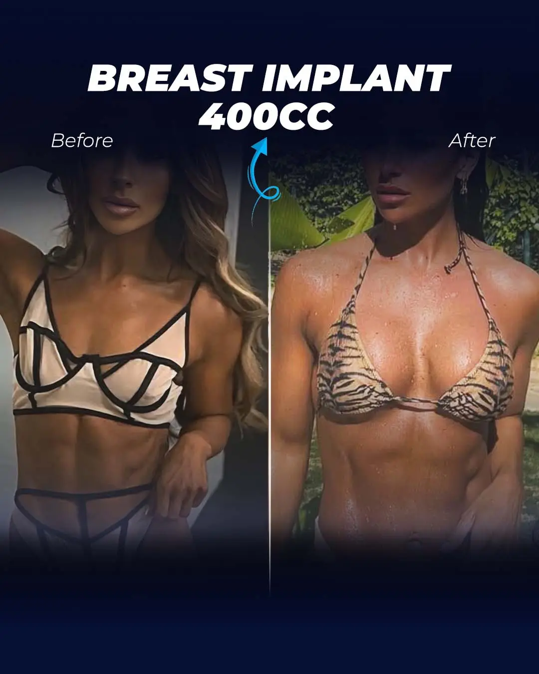 Breast Implant 400CC-Round