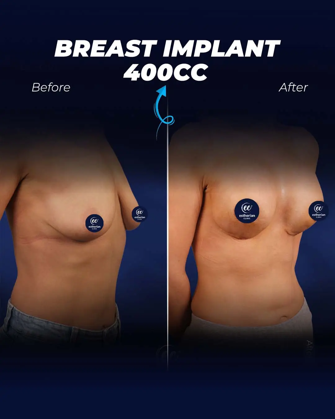 Breast Implant 400CC-Round