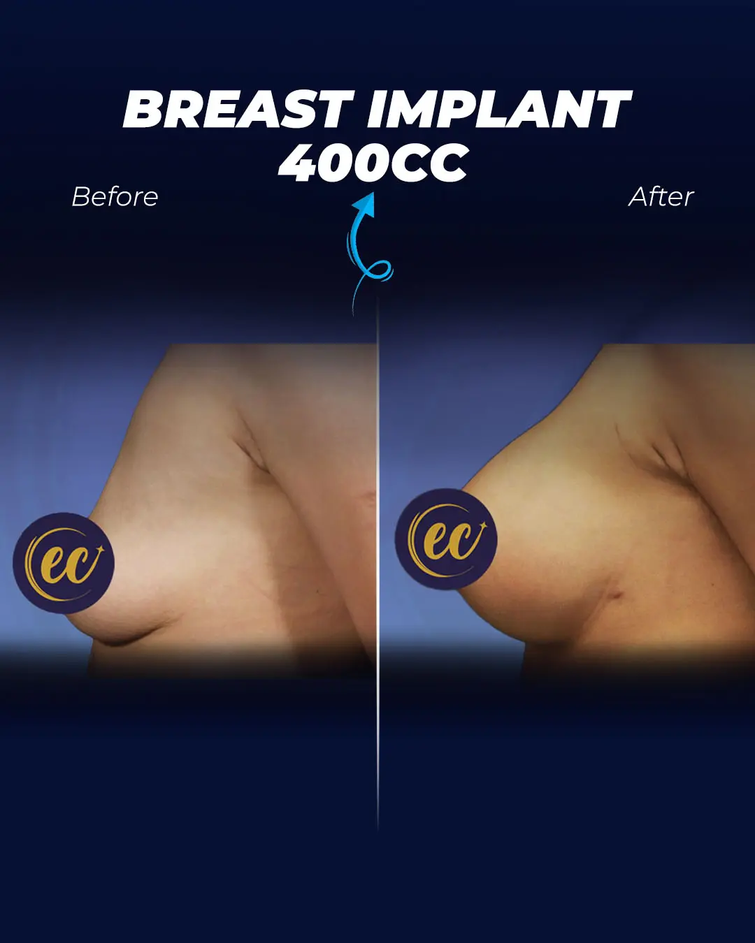 Breast Implant 400CC-Round