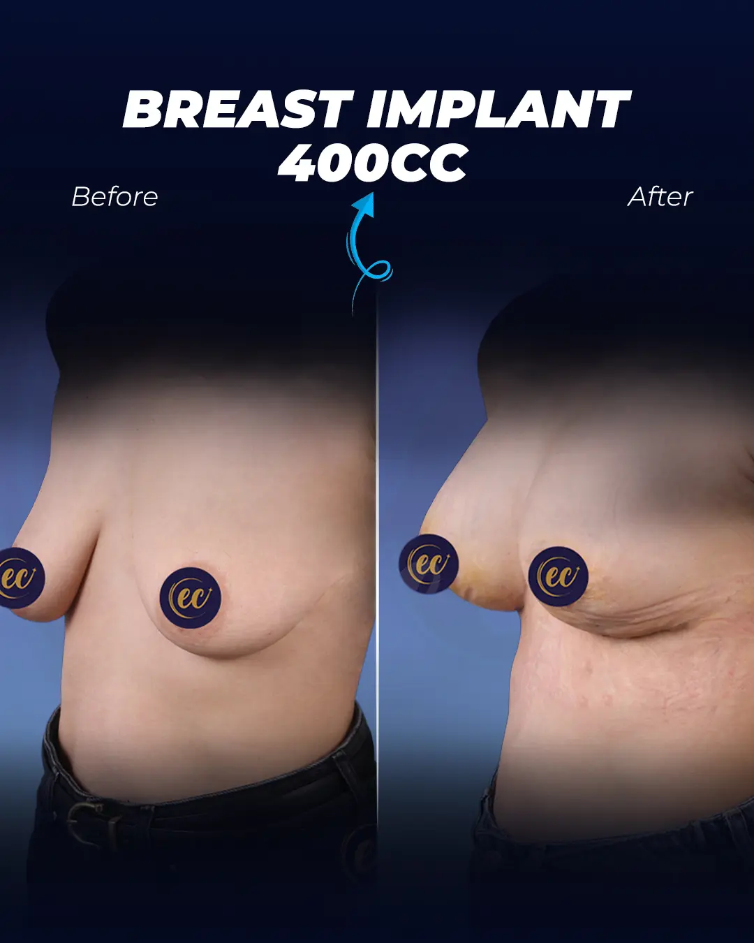 Breast Implants 400CC-Round