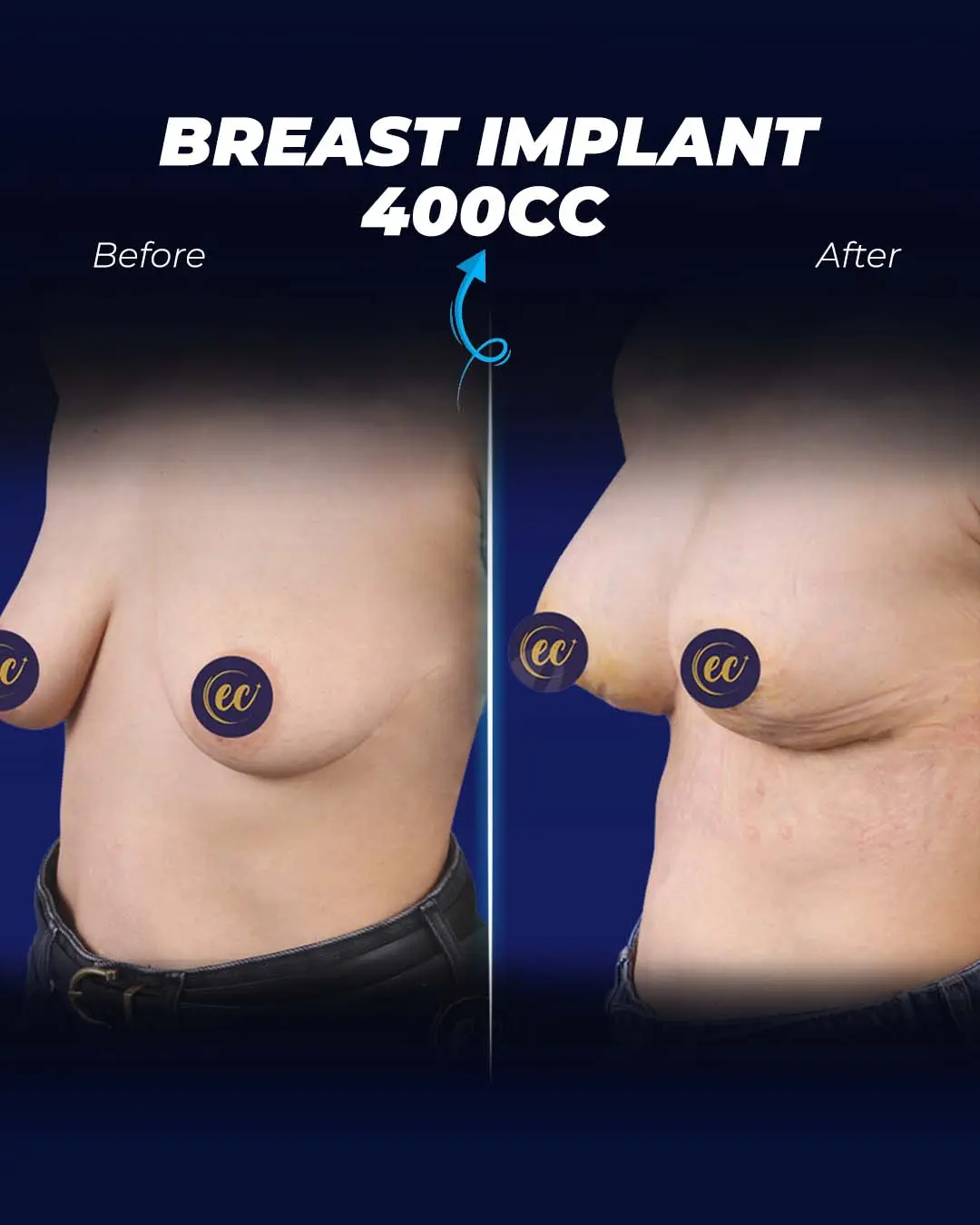 Breast Implant 400CC-Teardrop